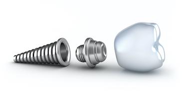 An illustration of a dental implant on a crown at CS Family Dentistry