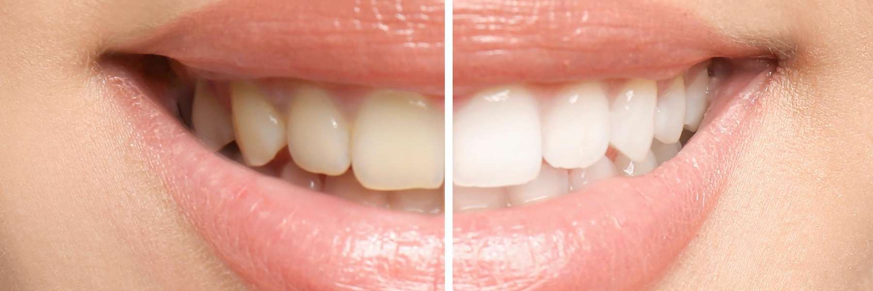 A picture of teeth before and after teeth whitening in Bastrop, TX