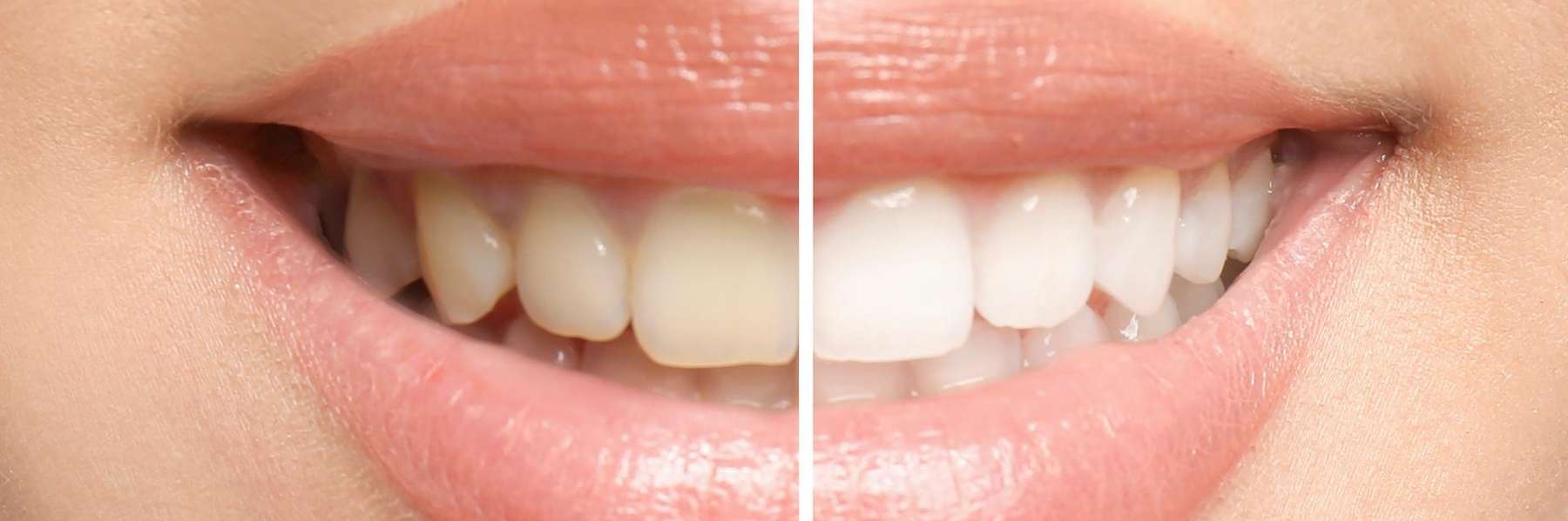 Before and after a Professional Teeth Whitening treatment in Bastrop, TX