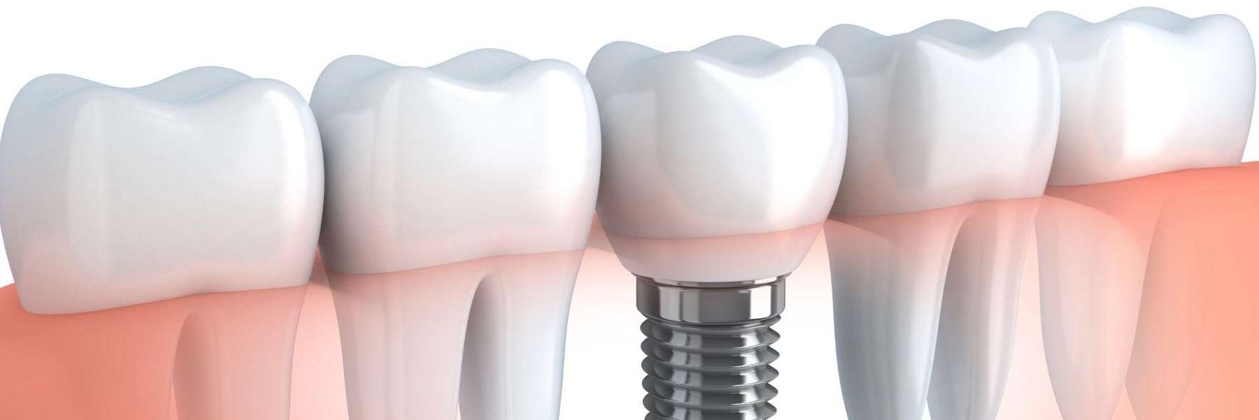 An illustration of a dental implant in Bastrop, TX