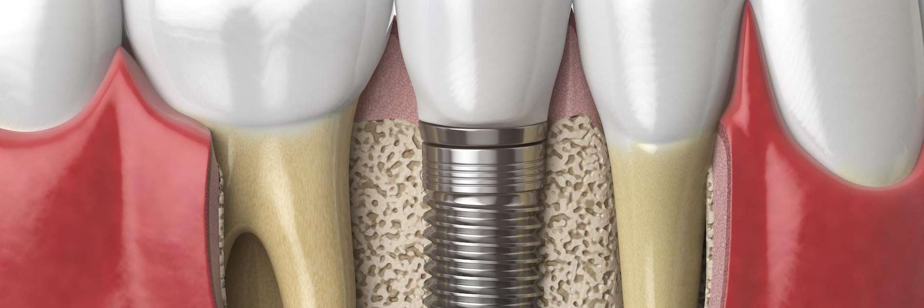 An illustration of a dental crown and implant in Bastrop, TX