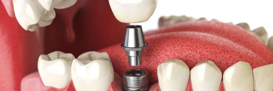 An illustration of a dental implant in Bastrop, TX