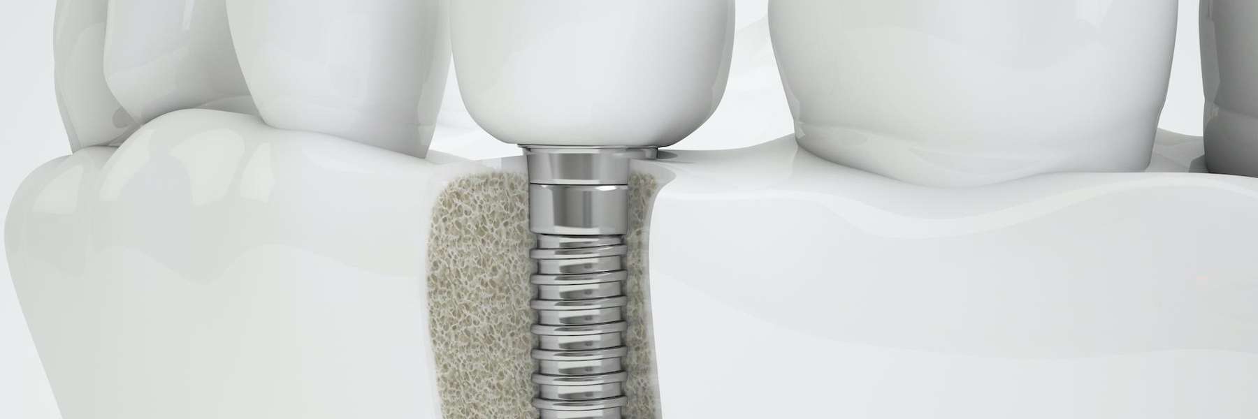 An illustration of a Dental Implants in Bastrop, TX