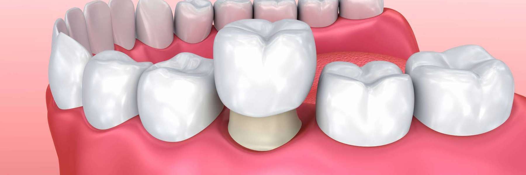 3D illustration showing a dental crown placed over a tooth