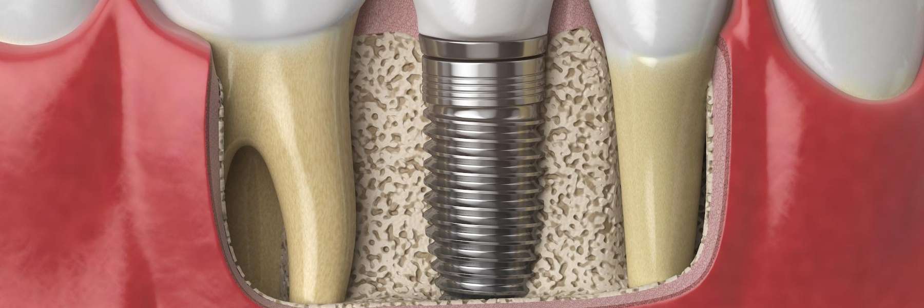 An illustration of a dental implant in Bastrop, Tx