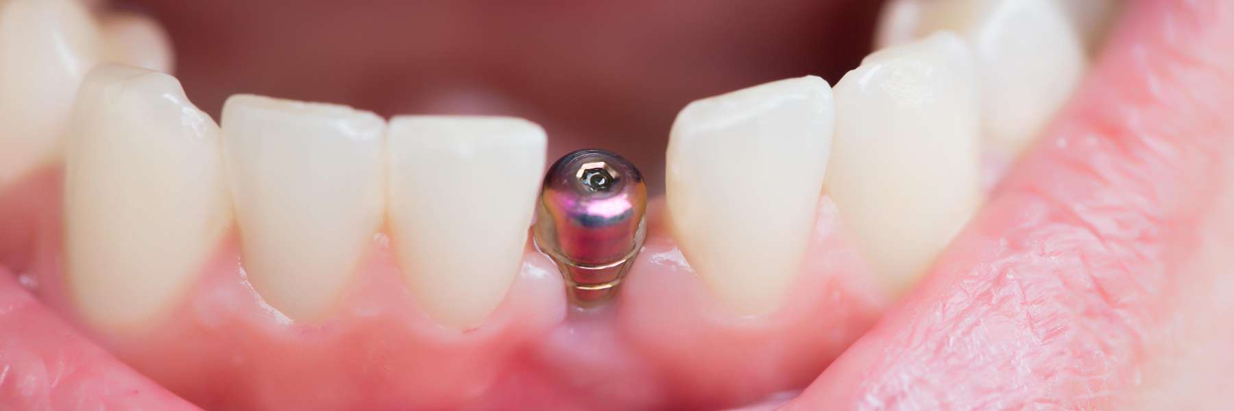 An illustration of a dental implant in Bastrop, TX