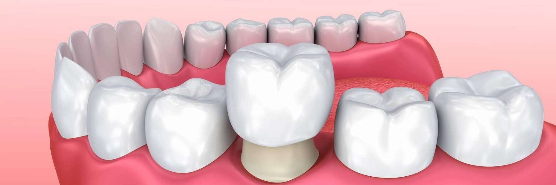 An illustration of a Dental Crown at CS Dentistry in Bastrop, TX!