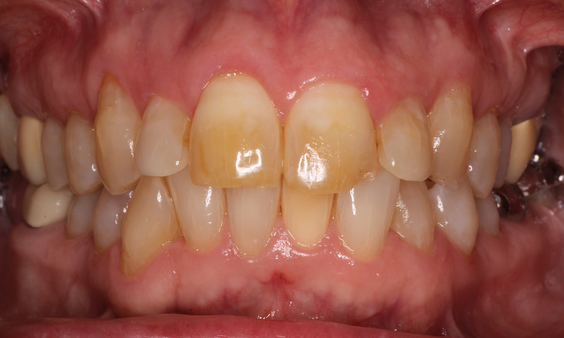 Patient with a front chipped tooth