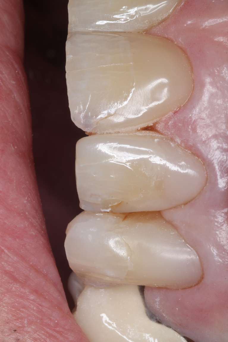 Patient's tooth after getting composites from CS Family Dentistry