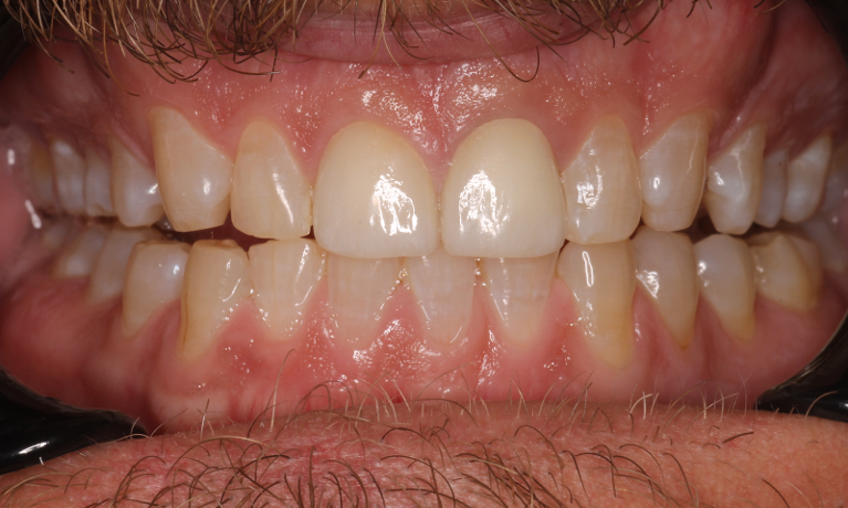 Anterior-Crowns-After-Image