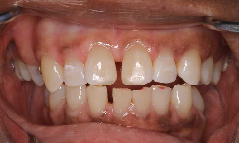 before and after photos of a patient who received a chipped front tooth repair