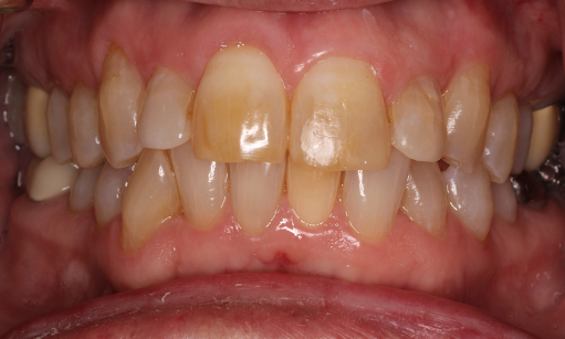 Chipped-Front-Tooth-Repair-After-Image