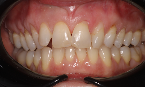 Chipped-Front-Tooth-Repair-After-Image