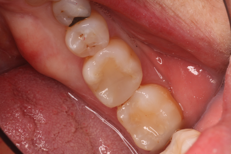 Patient's teeth after getting posterior fillings in Bastrop, TX