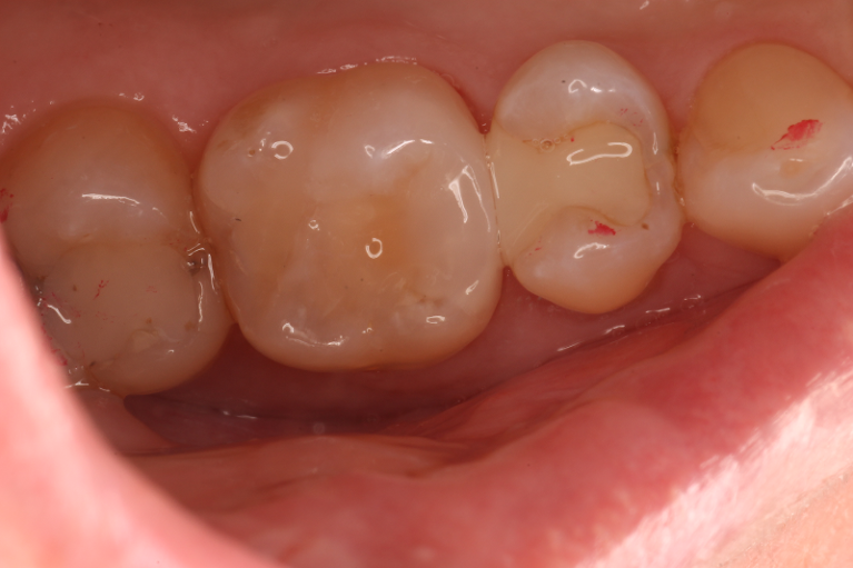 Patient's teeth after getting composites from CS Family Dentistry