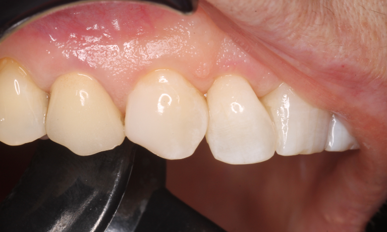 Diastema Closure at CS Family Dentistry
