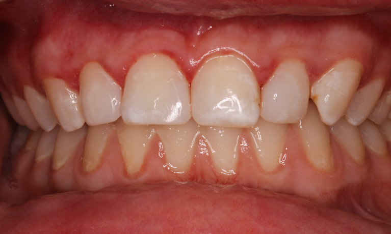 Patient's teeth after getting composites from CS Family Dentistry