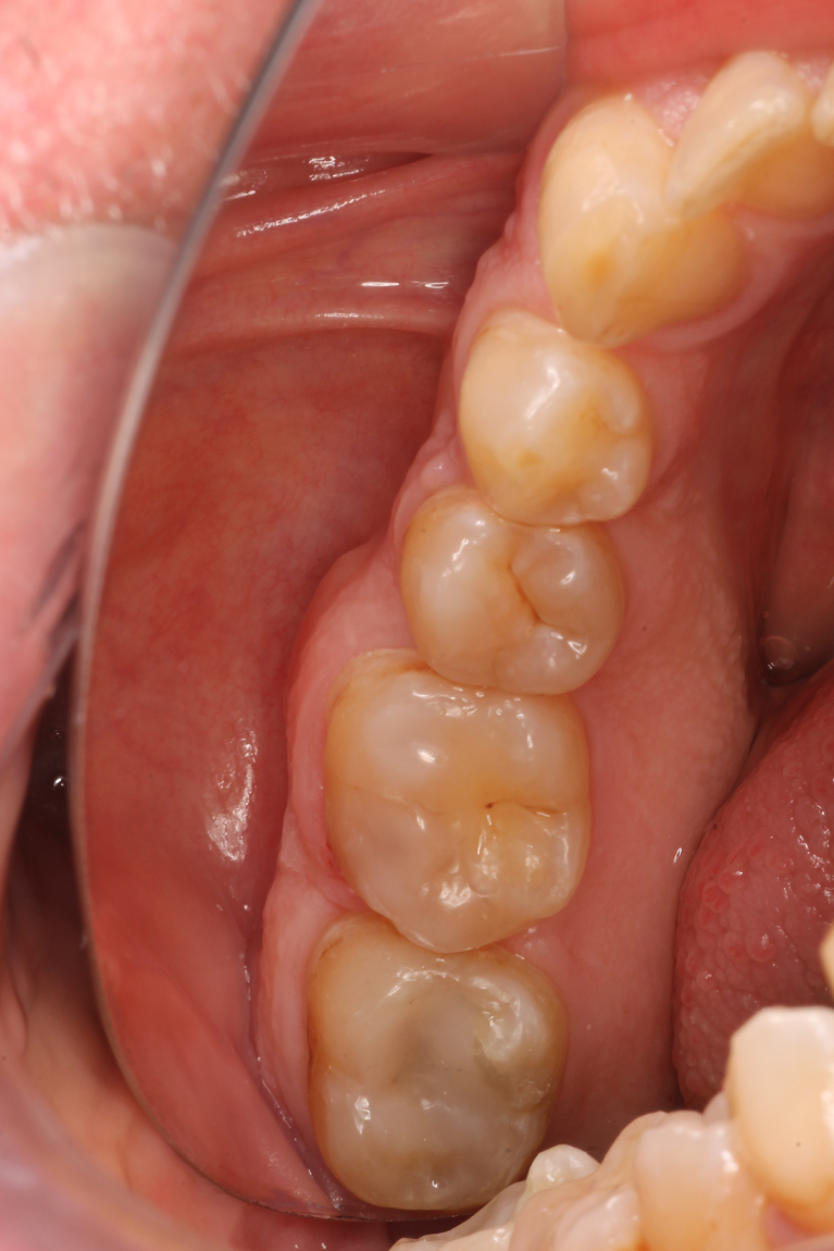 Patient's teeth after getting composites from CS Family Dentistry