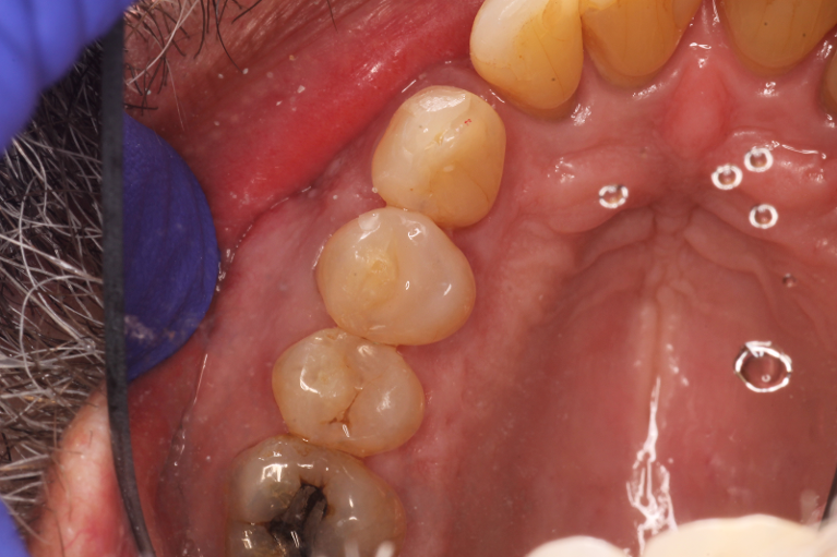Patient's teeth after getting composites from CS Family Dentistry