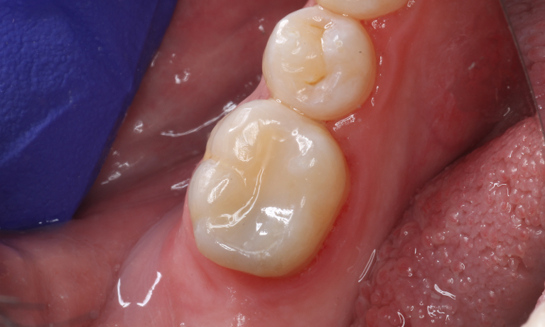 Direct-Composites-After-Image