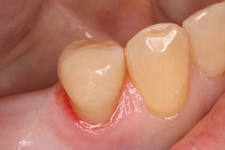 Direct-Composites-After-Image