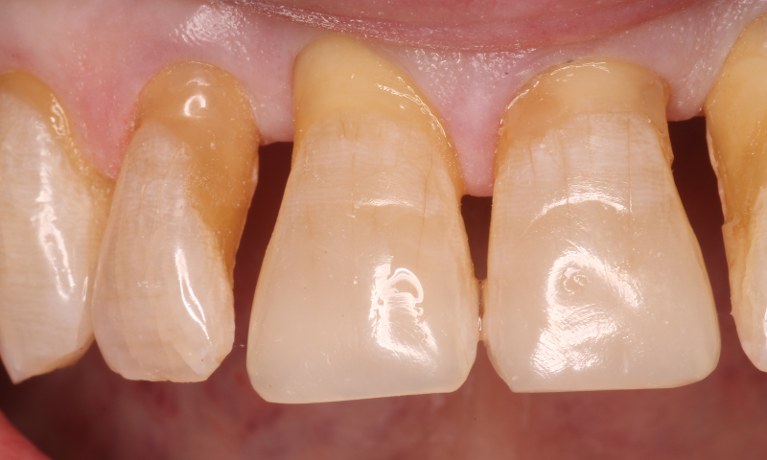 Patient's teeth after getting composites from CS Family Dentistry