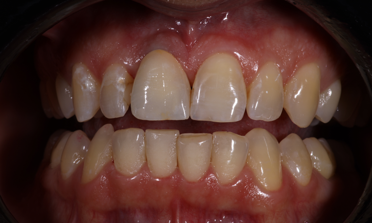 Implant-Single-Crown-Match-After-Image