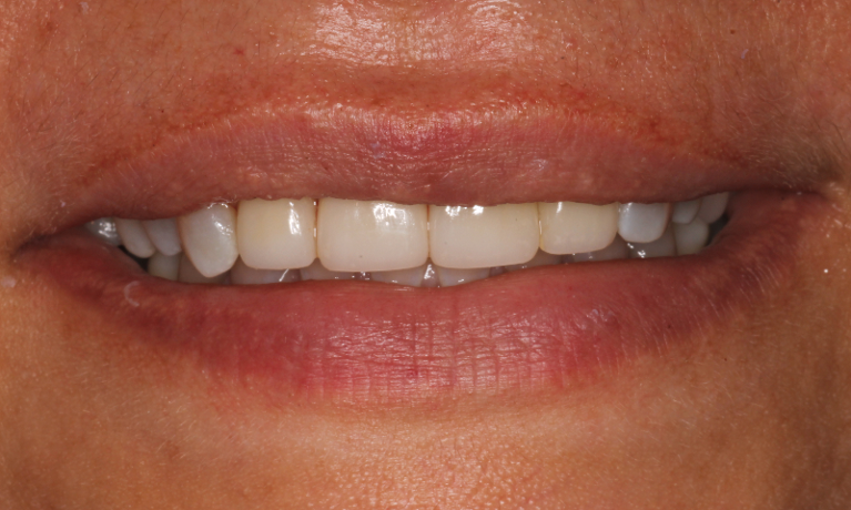 Patient after receiving smile enhancement anterior crowns
