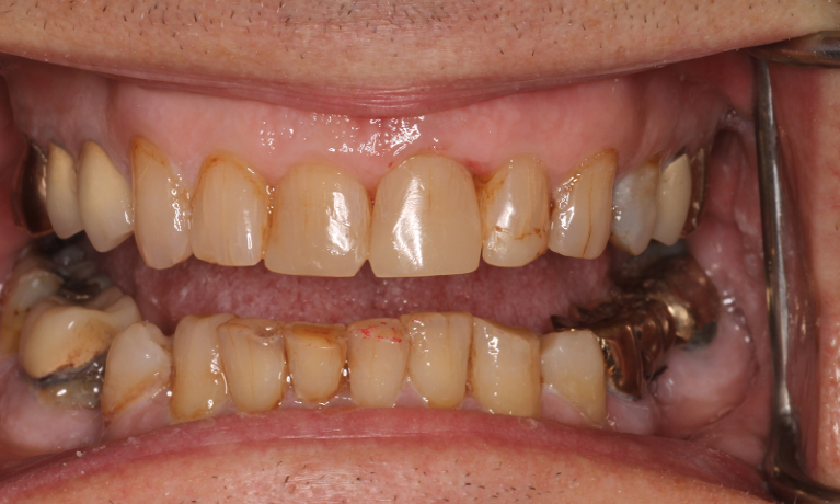 Patient's teeth after getting anterior composites from CS Family Dentistry
