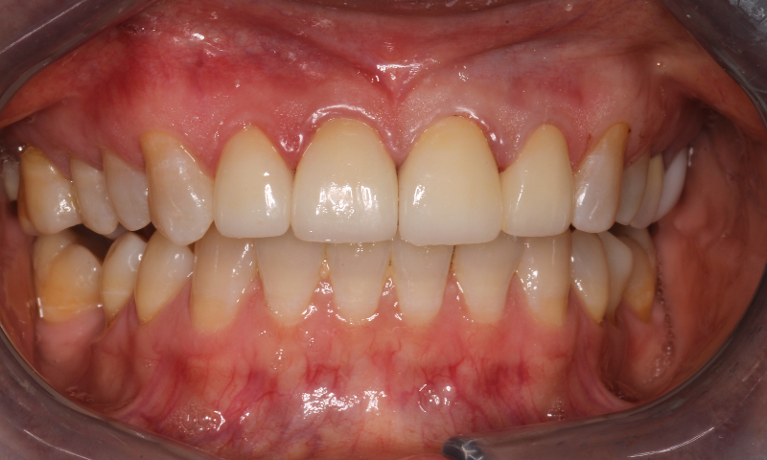 Patient after receiving smile enhancement anterior crowns