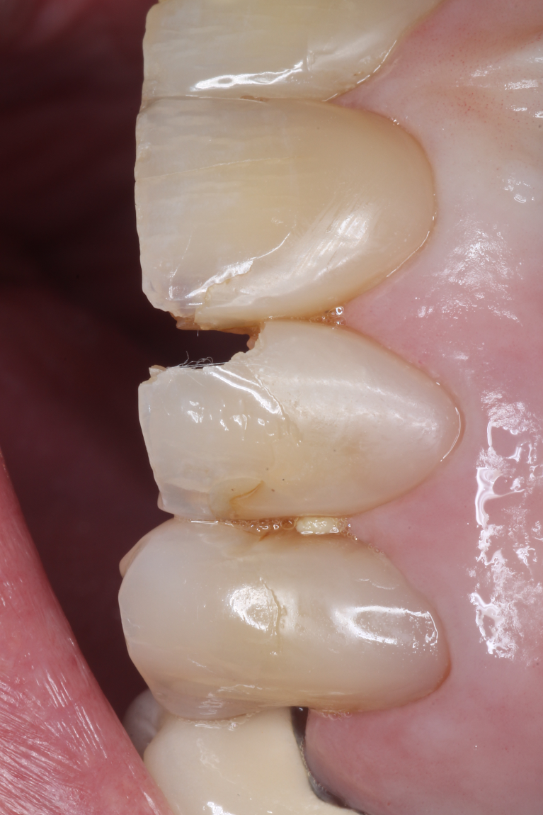 Patient's chipped tooth