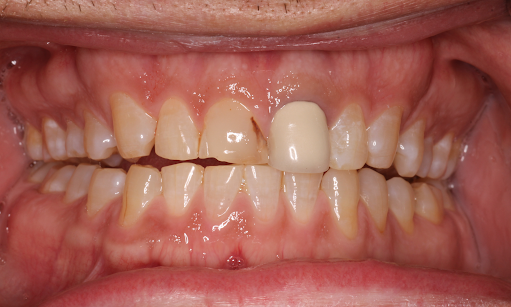 Anterior-Crowns-Before-Image