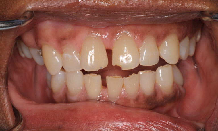 before and after photos of a patient who had a chipped front tooth