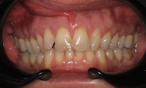 Chipped-Front-Tooth-Repair-Before-Image