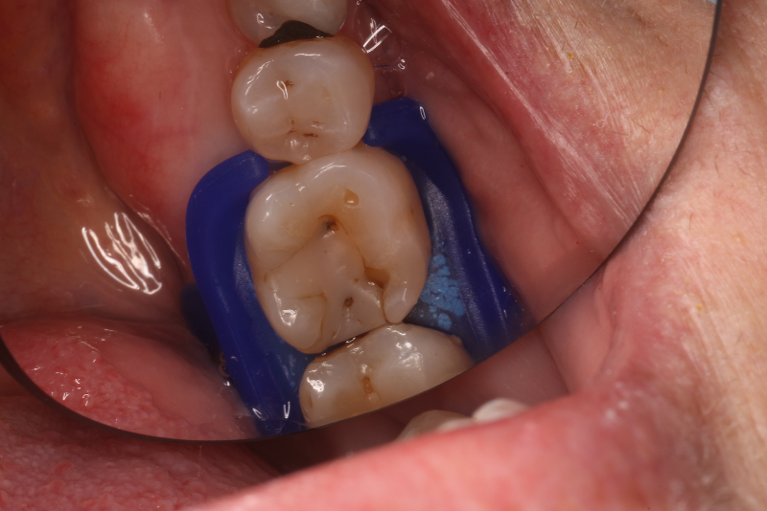Patient's teeth before fillings