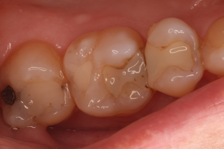 Patient's tooth with a cavity