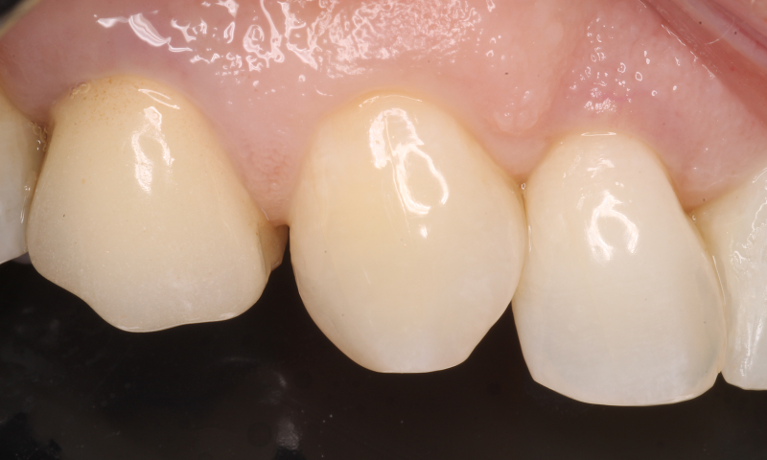 patient with Diastema