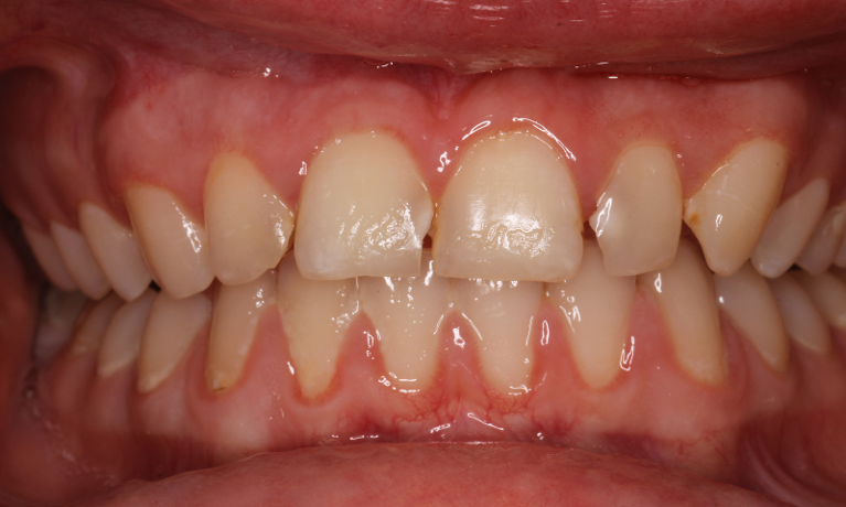 Patient's teeth before getting composites