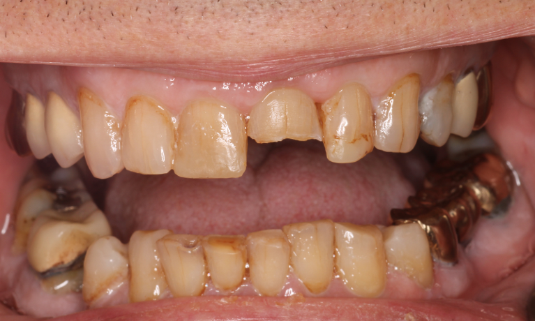Patient's chipped tooth before getting composites