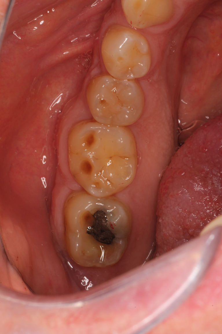 Patient's teeth before getting composites