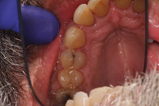 Patient's teeth before getting composites