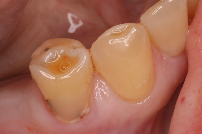 Direct-Composites-Before-Image