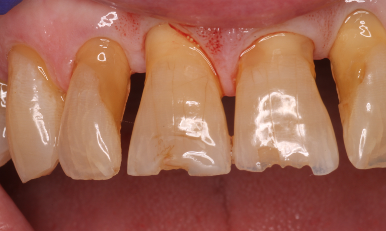 Patient's teeth before getting composites
