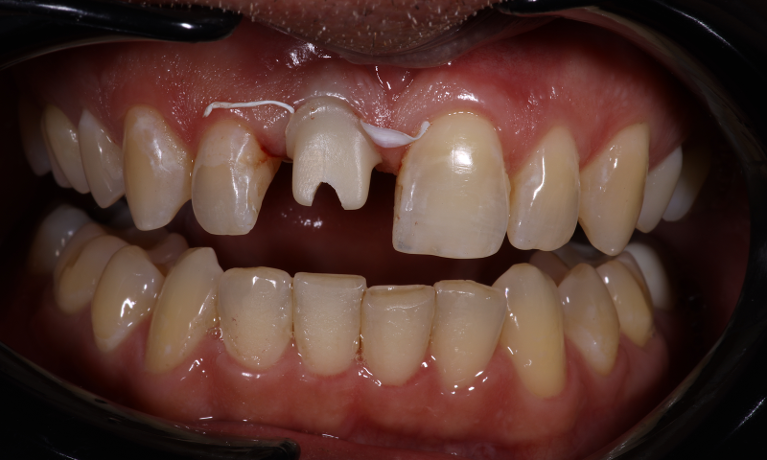 Implant-Single-Crown-Match-Before-Image