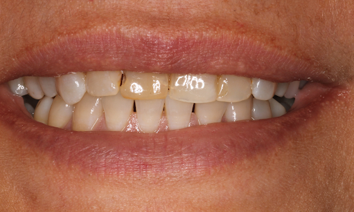 Patient before receiving smile enhancement anterior crowns