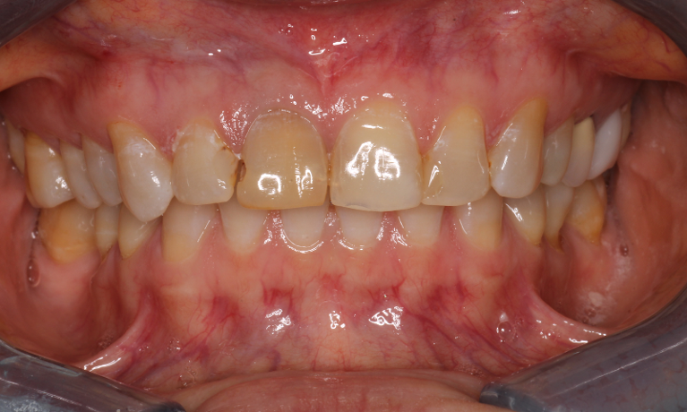 Patient before receiving smile enhancement anterior crowns